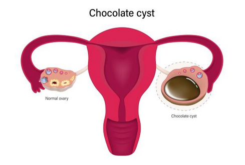 Ovarian Endometrioma Chocolate Cysts New York Gynecology Endometriosis