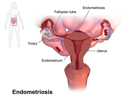 endometriosis research new york