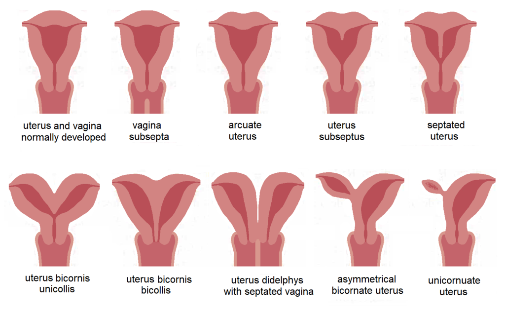 Uterine Anomalies