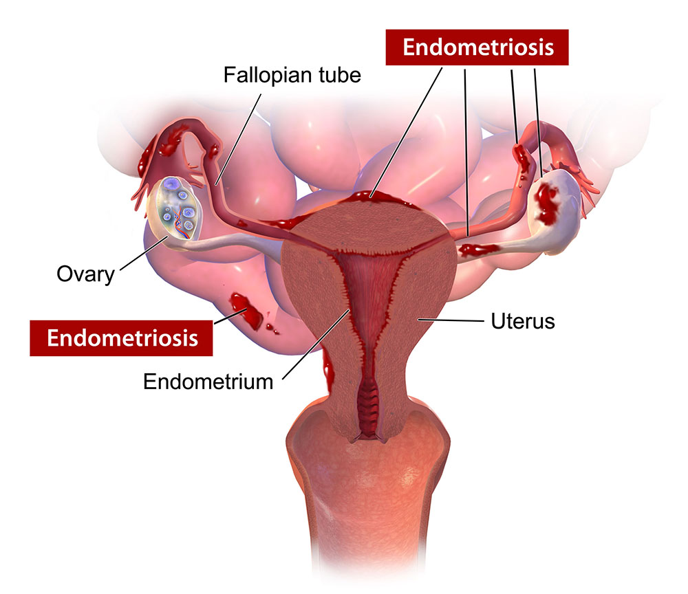 Endometriosis New York Gynecology