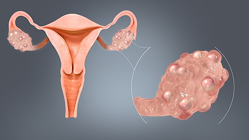 Ovarian Cysts and Pelvic Mass