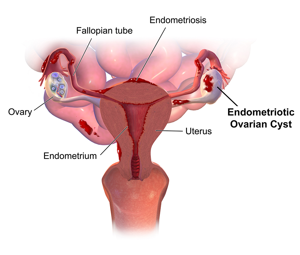 endometriotic ovarian cyst_new york gynecology endometriosis