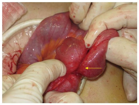 Adhesions in the small bowel resulting from the infiltration of endometriosis