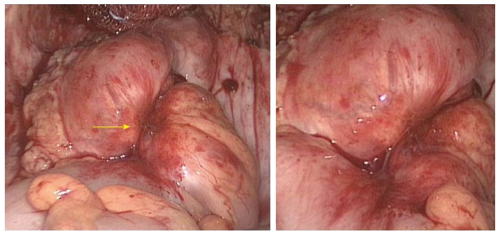 Deep Infiltrating Bowel Endometriosis Symptoms