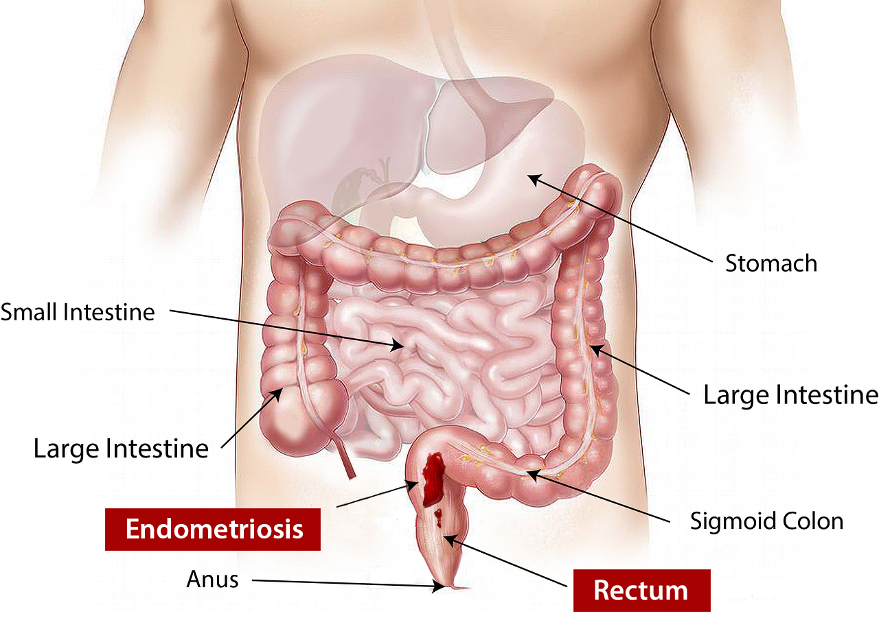 Rectum Endometriosis